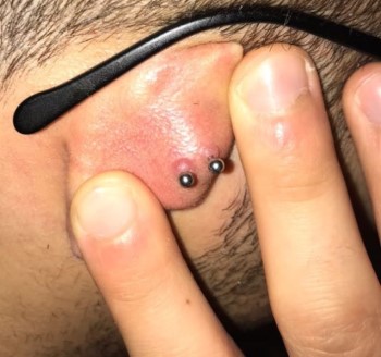 Cicatrice hypertrophique sur piercing oreille