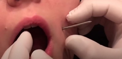 Se faire percer un piercing cheek, joue , fossette