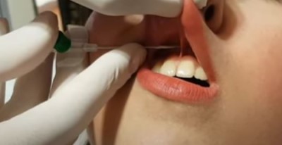 Faire un piercing smiley