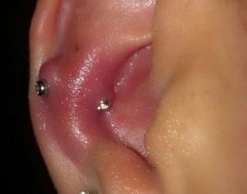 Infection d’un piercing oreille