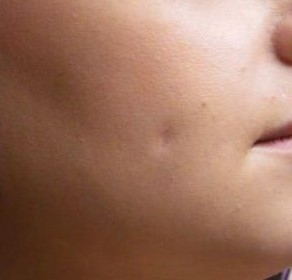 Complications du piercing cheek, joue , fossette