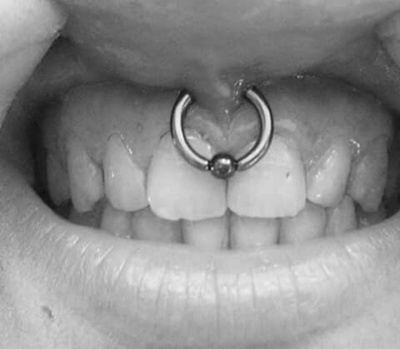  Piercing smiley / frein labial avec un anneau en gros plan