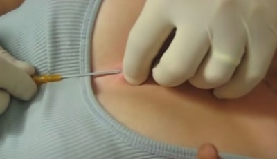 procédure de perçage du piercing cleavage, sternum A